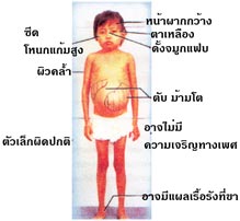  Thalassemia